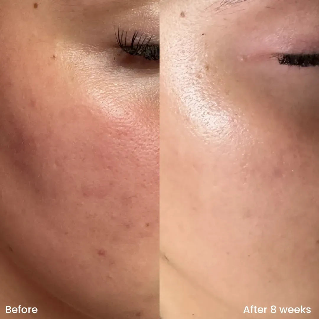 Teashell Niacinamide Brightening Serum | Fade Dark Spots, Acne Marks & Even Skin Tone | Teashell serum