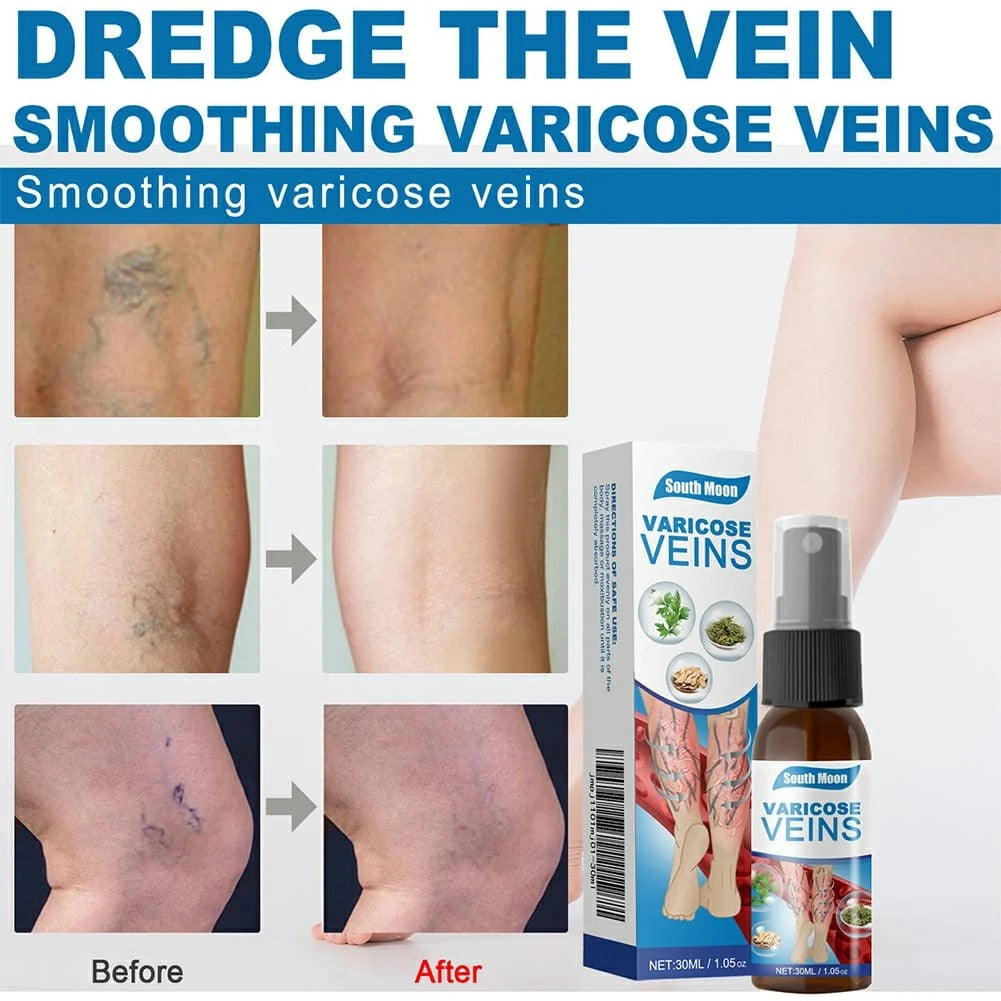 Varicose Veins Spray