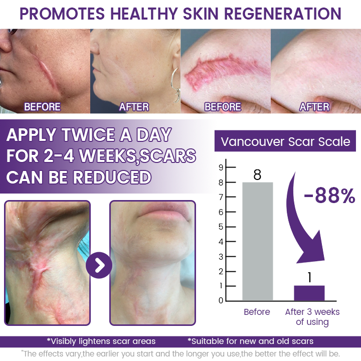 Timilk® ReGenScar Stem Cell Scar Gel – Advanced Skin Repair Formula for Acne, Stretch Marks & Surgical Scars | Fast Healing & Smooth Skin Care