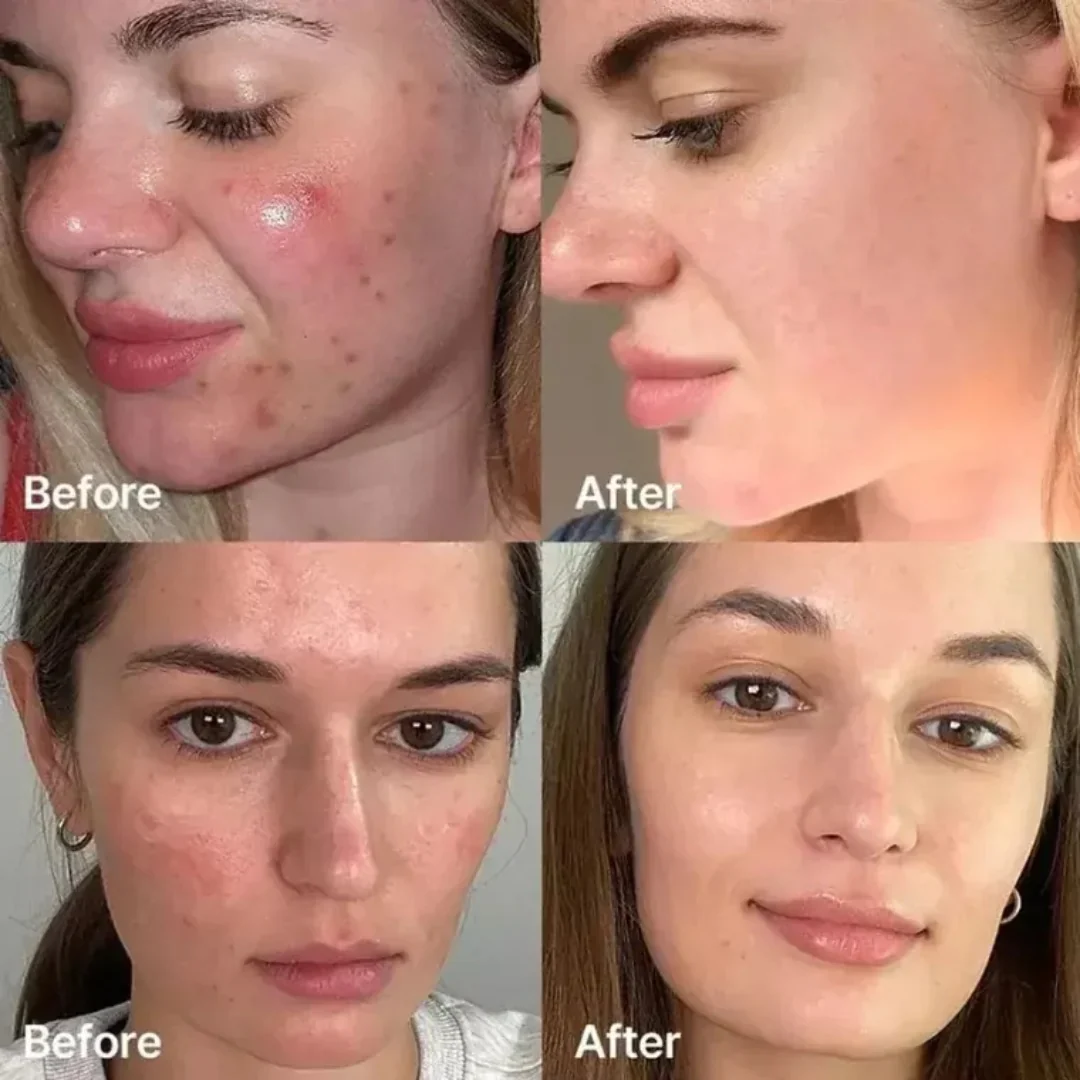 Teashell Niacinamide Brightening Serum | Fade Dark Spots, Acne Marks & Even Skin Tone | Teashell serum
