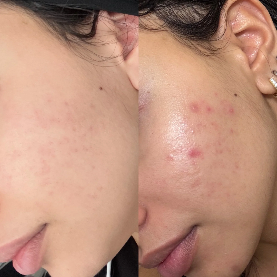 Teashell Niacinamide Brightening Serum | Fade Dark Spots, Acne Marks & Even Skin Tone | Teashell serum