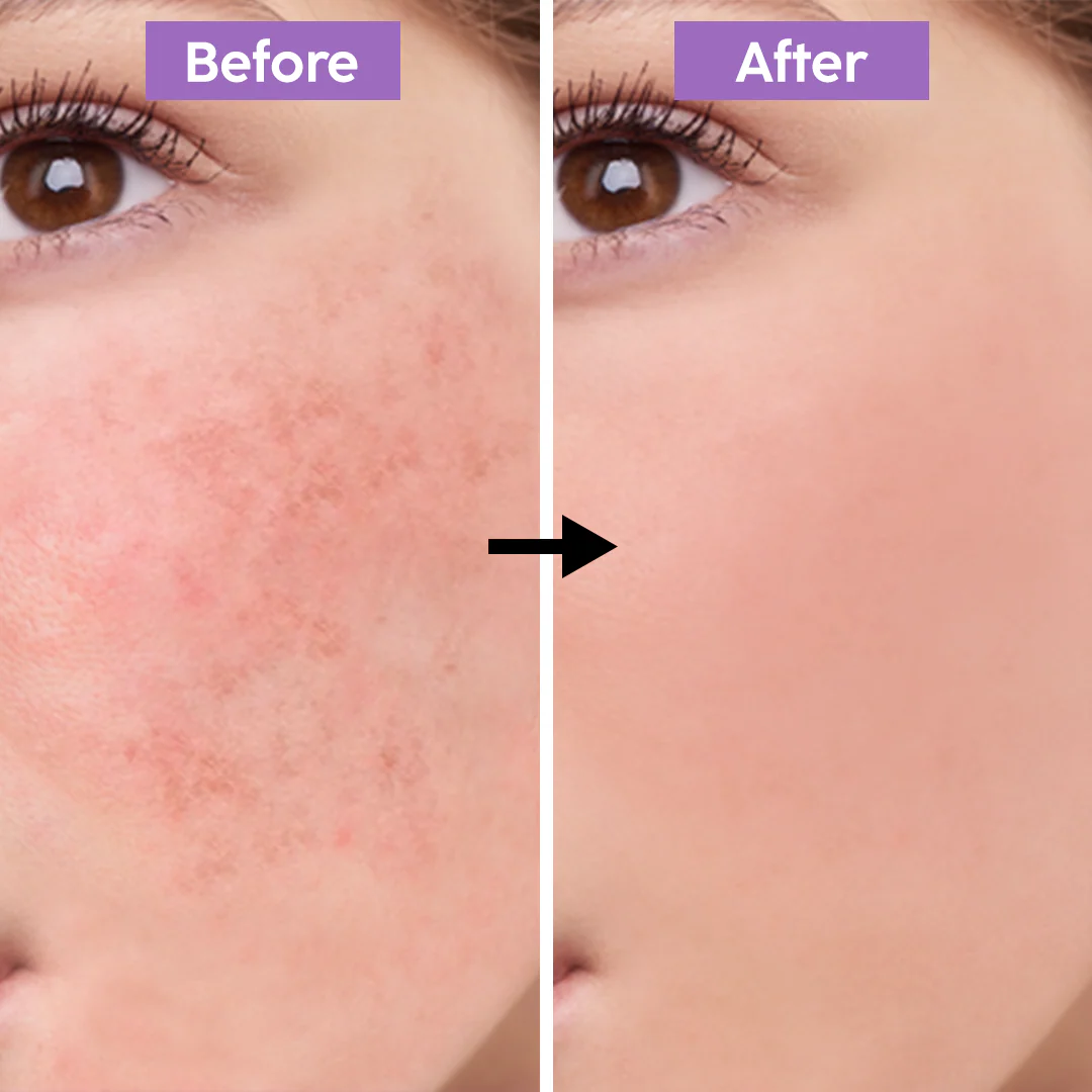Teashell Niacinamide Brightening Serum | Fade Dark Spots, Acne Marks & Even Skin Tone | Teashell serum